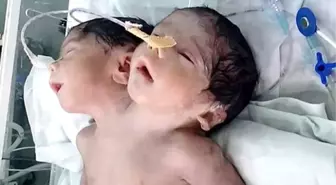 İki Başlı Bebek, Doğumundan 32 Saat Sonra Hayata Gözlerini Yumdu