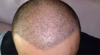 Saç Ektirdi Takımdan Kovuldu