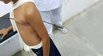 Kalbine Kebap Şişi Saplandı, Mucizevi Bir Şekilde Kurtuldu