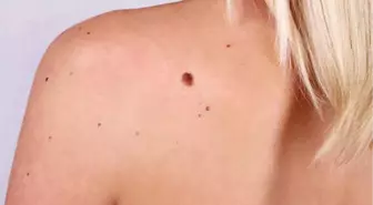 Güneş Lekelerine Doğal Maske Tarifleri