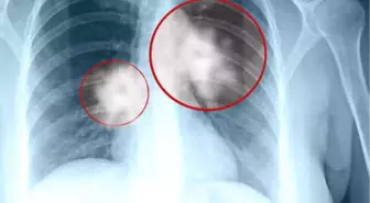 Sekonder Akciğer Kanserlerinde Cerrahi Mümkün