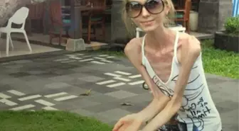 Anoreksiya Nedir, Neden Kaynaklanır? Anoreksiya Hastalığının Belirtileri Nelerdir?