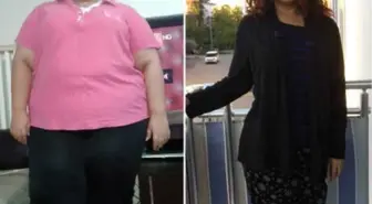 Tüp Mide Ameliyatıyla 15 Ayda 95 Kilo Verdi