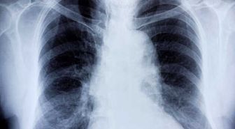 Bronşit Nedir? Akut Bronşit ve Kronik Bronşitin Tanımı