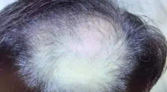 Saç Ekiminden Memnun Kalmayan Gıda Mühendisi Dava Açtı