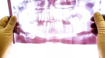 Türkiye'nin yüzde 70'inde çene eklem rahatsızlığı var