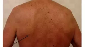 Bu tümör günlük yaşamı olumsuz etkileyebiliyor