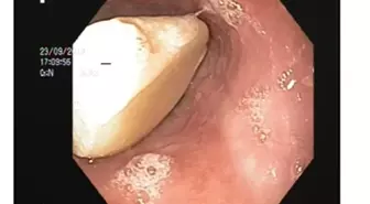 'çiğnemeden sarımsak yut' tavsiyesine uyunca canından oluyordu