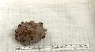 İdrar torbasından 130 gram ağırlığında taş çıkartıldı