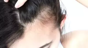 Sağlıklı Saçlara Kavuşmak İçin: Bioxcin