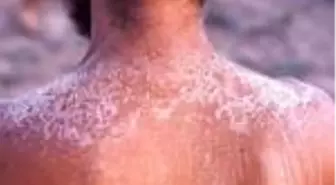 Güneş yanığına ne iyi gelir? Güneş yanıklarına ne iyi gelir? Güneş yanığı kaşıntısına iyi gelen şeyler nelerdir?