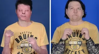 Dünyanın ilk başarılı çift el ve yüz nakli yapıldı: 'Bana verilen bu ikinci şans için minnettarız'