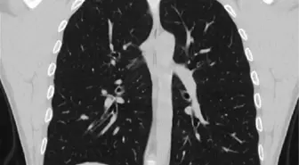 'Bilgisayarlı Tomografi akciğer kanserini yüzde 70 oranında erken yakalıyor'