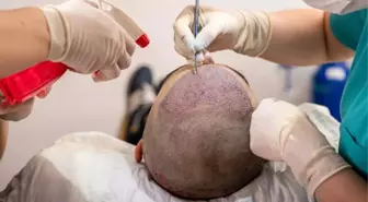 İngilizlerin saç ektirme oyunu! Türkiye'deki seyahat yasağını delip tatil yapıyorlar