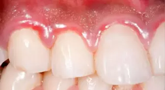 Diş iltihabına ne iyi gelir ve nasıl geçer? Diş iltihabı neden olur? Evde diş iltihabına iyi gelen bitkisel ve doğal yollar