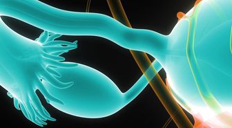 Yumurtalık kanseri nedir? Yumurtalık kanseri belirtileri nelerdir? Yumurtalık kanseri teşhisi ve tedavisi nasıl yapılır?