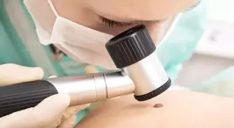Aman dikkat! Vücudunuzdaki 'ben'ler kanserin habercisi olabilir!