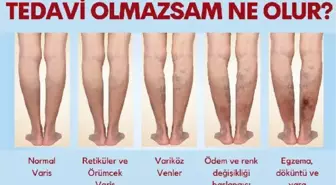 TEDAVİ EDİLMEYEN VARİSE DİKKAT; ÖMÜR BOYU VARİS ÇORABI GİYMEK ZORUNDA KALABİLİRSİNİZ