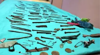 Nails, knives, tweezers: 158 pieces of metal were removed from the stomach of a woman