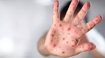 Maymun Çiçeği hastalığını 1 saatte saptayabilen PCR Tanı Kiti geliştirildi