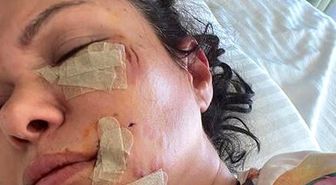Son dakika haberi... Ünlü şarkıcı Tuğba Altıntop köpek saldırısına uğradı