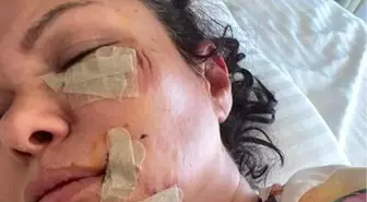Son dakika haberi... Ünlü şarkıcı Tuğba Altıntop köpek saldırısına uğradı