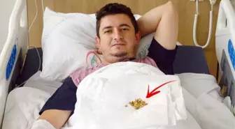 6 ayda 2 operasyon geçiren hastanın mesanesinden 66 adet taş alındı