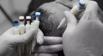 Estpital International: Saç Ekiminde DHI Yöntemi Başarı Oranını Arttırıyor
