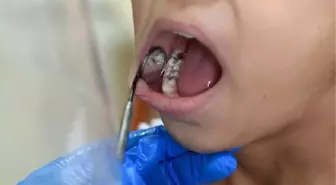 TEDAVİ EDİLMEYEN DİŞ İLTİHABINDA ÖLÜMCÜL 'MEDİASTİNİT' RİSKİ