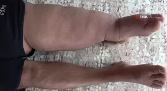 5 yıl önce tekstil fabrikasında kaza geçiren gencin ayağının şişmesiyle hayatı kabusa döndü