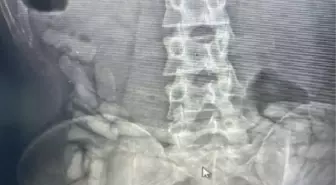 BAĞIRSAKLARINDAN 432 GRAM AFYON SAKIZI ÇIKTI
