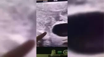 Anne karnındaki bebeğe stent takıldı