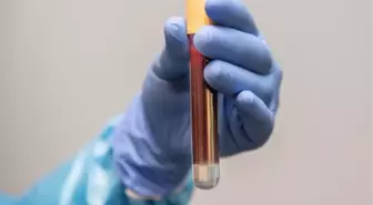 ABD'li bilim insanları, Alzheimer'ı teşhis eden kan testi geliştirdi