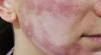 Cansu'nun yüzünü yakan güzellik merkezi sorumlularına ceza