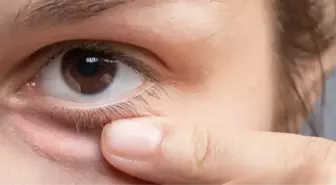 Arpacık nasıl geçer? Gözde arpacık neden çıkar, tedavisi nedir? Arpacığa ne iyi gelir?