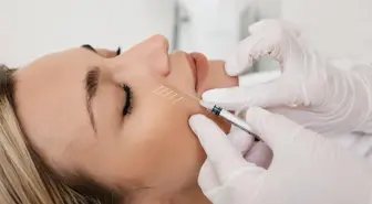 What is the best filler for nasolabial lines? Can I smile after nasolabial filler?