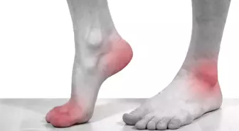 Gut hastalığı nedir, belirtileri neler? Gut hastalığı nasıl geçer? Gut hastalığı tedavisi nasıl?