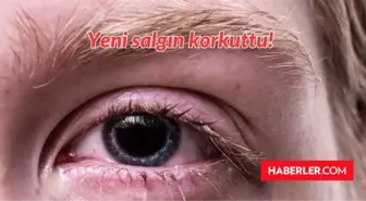 Kırmızı Göz hastalığı nedir, tedavisi var mı? Pakistan'da çıkan yeni virüs, salgın ne?