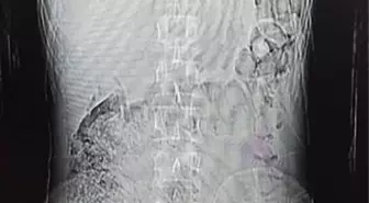 Erzurum'da İran uyruklu şüphelinin mide ve bağırsağından sentetik uyuşturucu çıktı