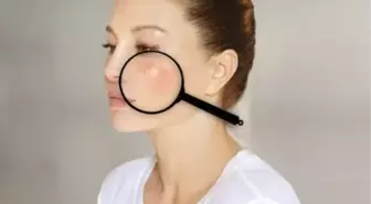 Kelebek hastalığı sonradan olur mu? Kelebek hastalığı (lupus) nedir, doğuştan mı olur?