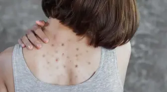 Lupus hastalığı nedir, belirtileri neler? Lupus hastalığı tedavisi var mı?