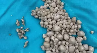 Tayvan'da 20 yaşındaki kadının böbreklerinden 300'den fazla taş çıkarıldı
