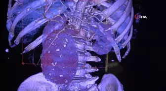 Aort damarı kalp büyüklüğünde şişen hastayı aynı anda 2 ameliyatla hayatta tuttular