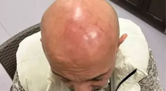 Bekçiler Tarafından Darbedilen Muzaffer Akdaş'tan Şikayetçiyim