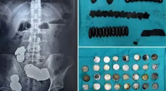Çinkonun vücut geliştirdiğini düşünen halterci, 39 madeni para ve 37 mıknatısı yuttu