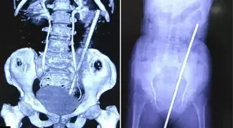 Yaşlı kadın, tarlada çalıştığı sırada 60 cm uzunluğundaki paslı metal çubuğa saplandı