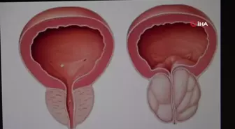 İyi Huylu Prostat Büyümesi Tedavisinde HoLEP Ameliyatı ile Yeni Bir Dönem