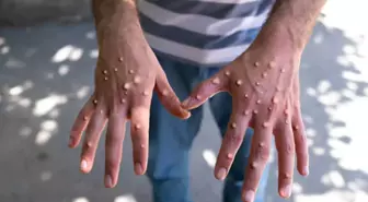 Maymun çiçeği alarmı! Ülkede 12 günlük kapanma ilan edildi