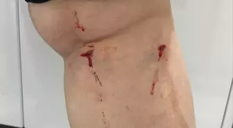 Sokak Köpeklerinin Saldırısına Uğrayan Öğrenci Hastaneye Kaldırıldı
