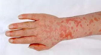 Yunanistan'da Strep-A bakterisi nedeniyle okullar kapatıldı
